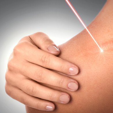 Ablacyjne lasery frakcyjne - klucz do samoregeneracji