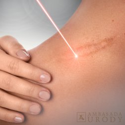 Jak się pozbyć blizn? Najskuteczniejsze zabiegi