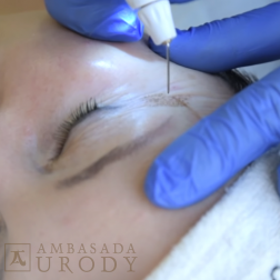 Jak usunąć opadające powieki w gabinecie bez skalpela?