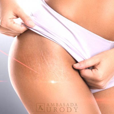 Jak powstają blizny? Czy można im przeciwdziałać?