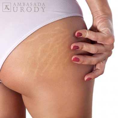 Rozstępy — najskuteczniejsze zabiegi