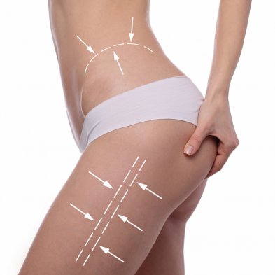 Jak pozbyc się cellulitu? #OkiemPacjenta