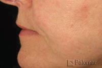 Laserowe Ujędrnianie Skóry