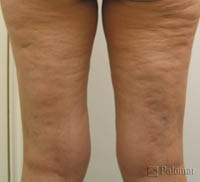 Laserowe Ujędrnianie Skóry