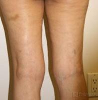 Laserowe Ujędrnianie Skóry