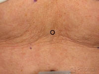 Laserowe Ujędrnianie Skóry