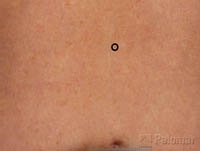 Laserowe Ujędrnianie Skóry