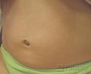 Laserowe Ujędrnianie Skóry