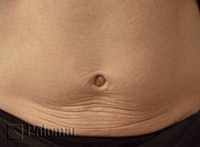 Laserowe Ujędrnianie Skóry