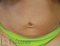 Laserowe Ujędrnianie Skóry