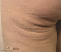 Laserowe Ujędrnianie Skóry