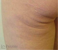 Laserowe Ujędrnianie Skóry