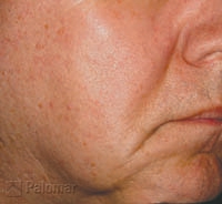 Laserowe Ujędrnianie Skóry