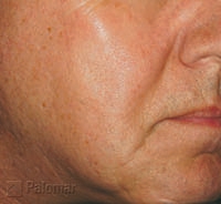 Laserowe Ujędrnianie Skóry