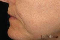 Laserowe Ujędrnianie Skóry