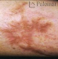 Laserowe Usuwanie Blizn