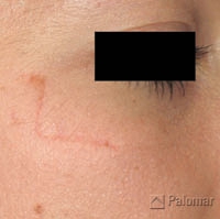 Laserowe Usuwanie Blizn