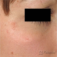 Laserowe Usuwanie Blizn