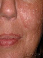 Laserowe Usuwanie Blizn