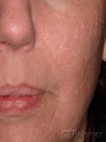 Laserowe Usuwanie Blizn