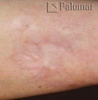 Laserowe Usuwanie Blizn