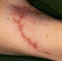 Laserowe Usuwanie Blizn