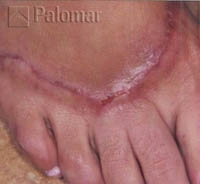 Laserowe Usuwanie Blizn