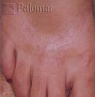 Laserowe Usuwanie Blizn