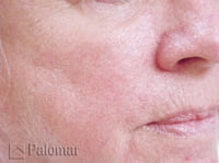 Rumien i&nbsp;Zmiany Naczyniowe