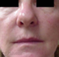 Rumien i&nbsp;Zmiany Naczyniowe