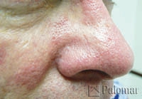 Rumien i&nbsp;Zmiany Naczyniowe