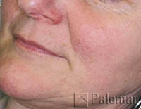 Rumien i&nbsp;Zmiany Naczyniowe