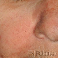 Rumien i&nbsp;Zmiany Naczyniowe