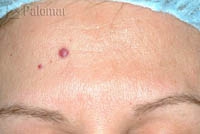 Rumien i&nbsp;Zmiany Naczyniowe