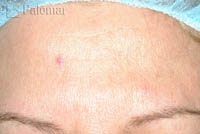 Rumien i&nbsp;Zmiany Naczyniowe