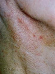 Rumien i&nbsp;Zmiany Naczyniowe