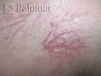 Laserowe Usuwanie Naczynek na Nogach