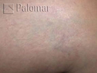 Laserowe Usuwanie Naczynek na Nogach