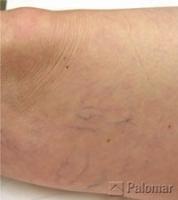 Laserowe Usuwanie Naczynek na Nogach