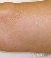 Laserowe Usuwanie Naczynek na Nogach