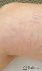 Laserowe Usuwanie Naczynek na Nogach