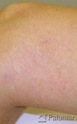 Laserowe Usuwanie Naczynek na Nogach