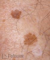 Laserowe Usuwanie Przebarwień