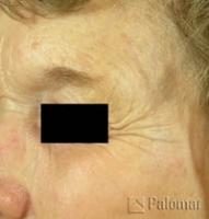 Laserowe Usuwanie Przebarwień