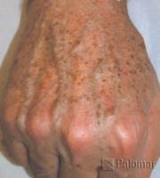 Laserowe Usuwanie Przebarwień