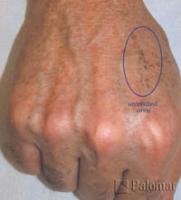 Laserowe Usuwanie Przebarwień