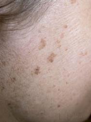 Laserowe Usuwanie Przebarwień