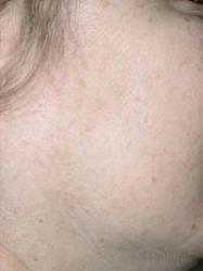 Laserowe Usuwanie Przebarwień