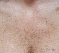 Laserowe Usuwanie Przebarwień