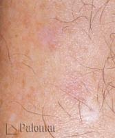 Laserowe Usuwanie Przebarwień